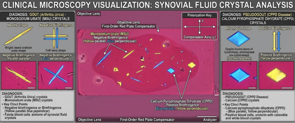 Polarizing biological microscope image showing synovial fluid crystal analysis for gout and pseudogout diagnosis, with birefringence examples
